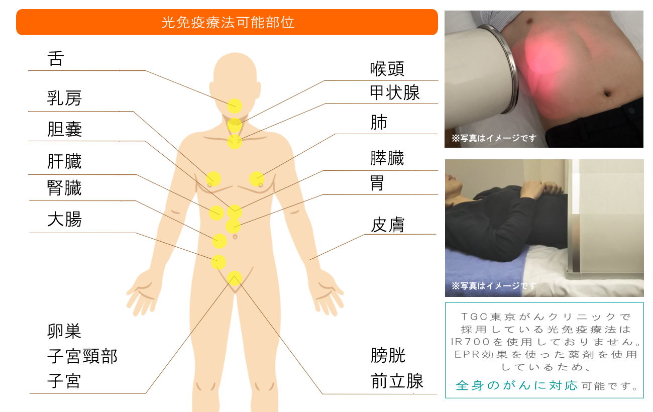 光免疫療法(茨城の方へご紹介)2