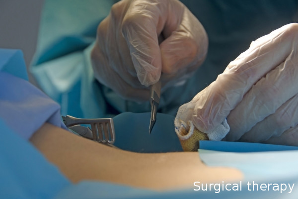 外科療法（手術)