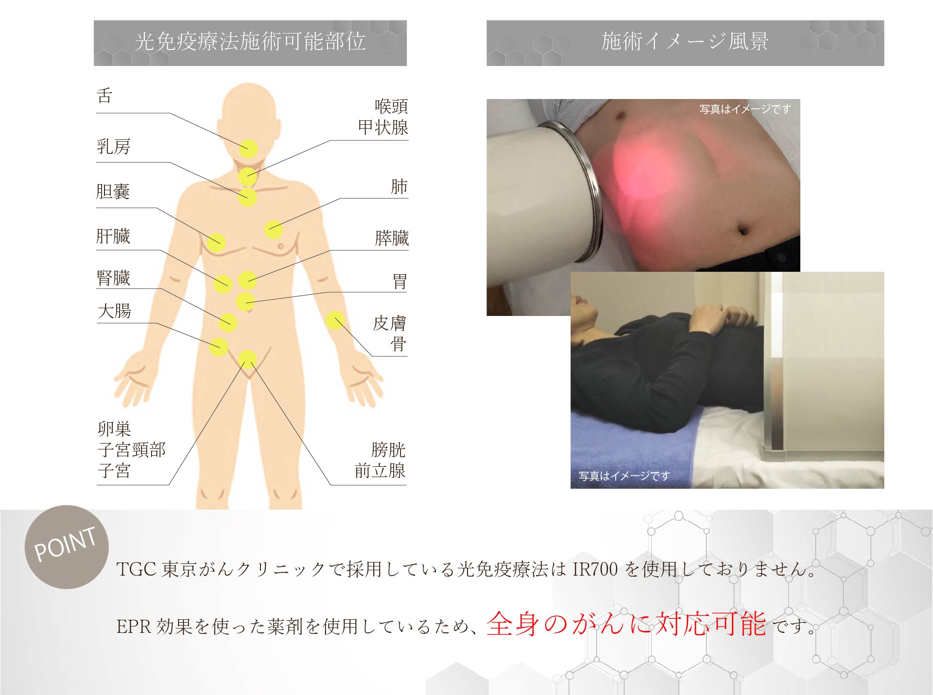 TGCの光免疫療法は全身に対応