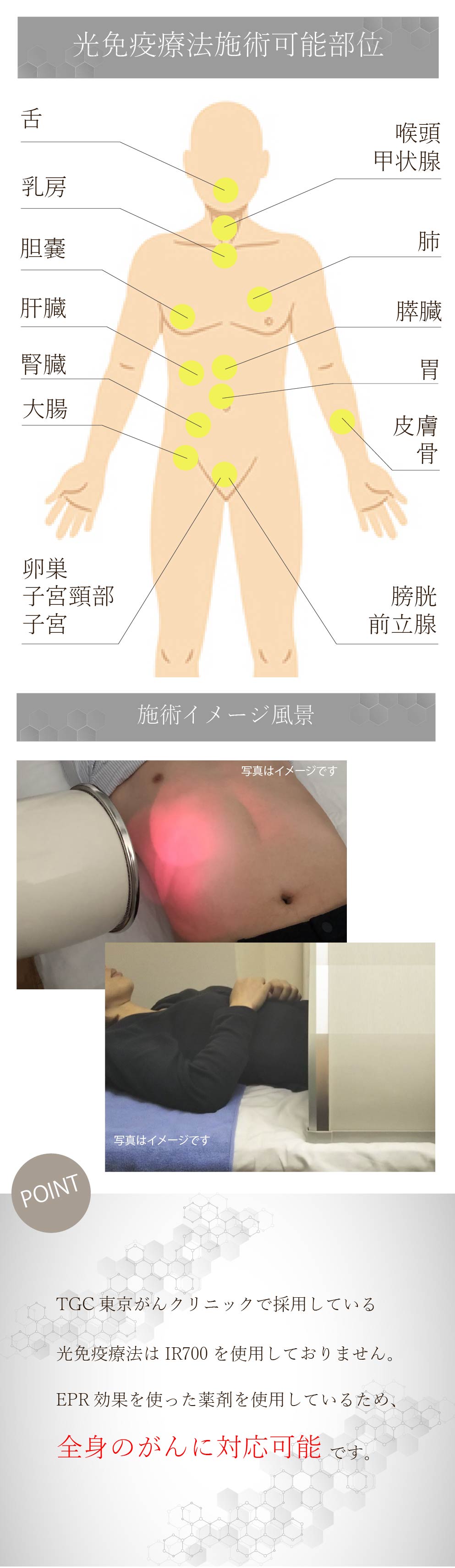 TGCの光免疫療法は全身に対応
